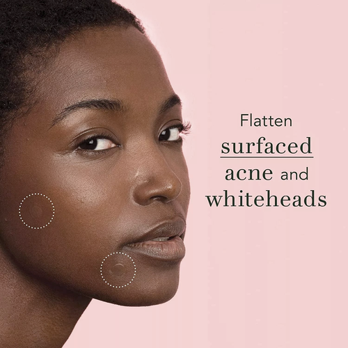 Invisible Acne Patches – Hydrocolloid Zit Stickers | Extra Adhesion & Overnight Repair